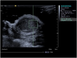 Fig 1: Virtual Touch Tissue Quantification, the shear wave speed through a...