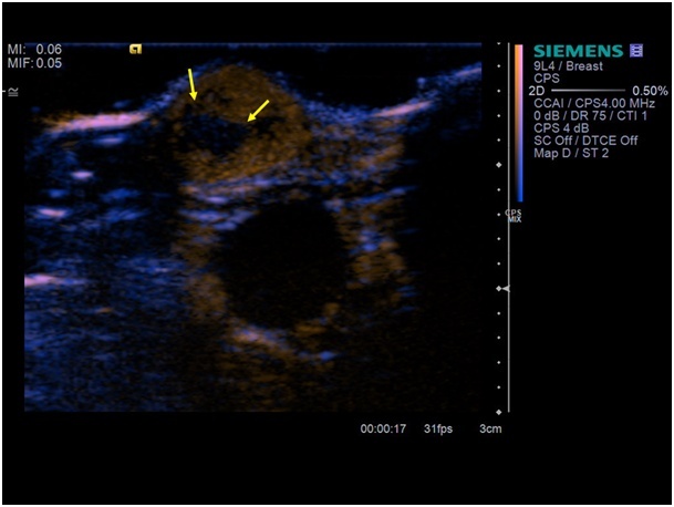 Figure 3: Contrast enhanced ultrasound visualized the small tumor with a...
