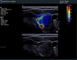 Photo: Promising preliminary breast trial results