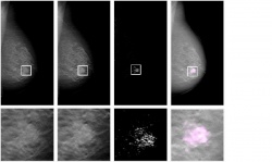 Slit-scan photon-counting spectral imaging: 3 mm tomosynthesis slices of a...