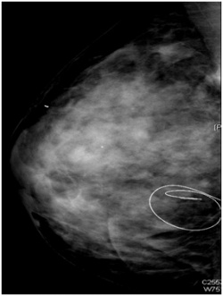 Standard mammography image
