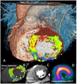 Figure 1: 64-year-old man with past history of inferolateral myocardial...