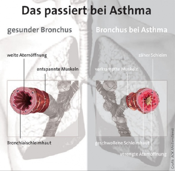 Photo: Neue Ansätze zum schweren Asthma
