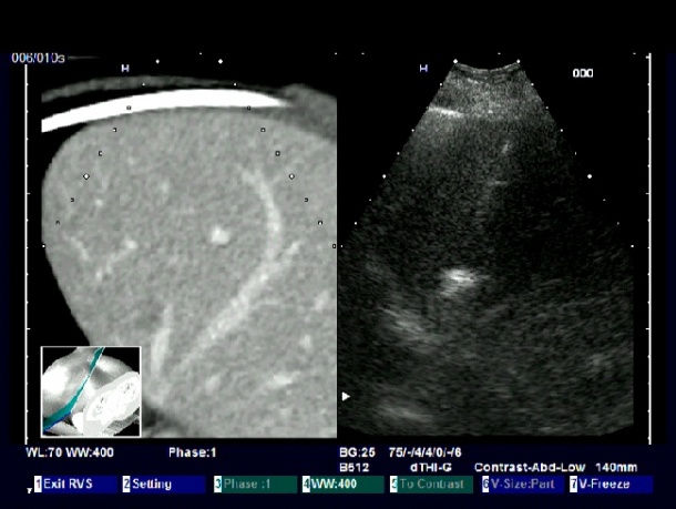 US-CT co-registered image during the ablation of a breast cancer metastasis...