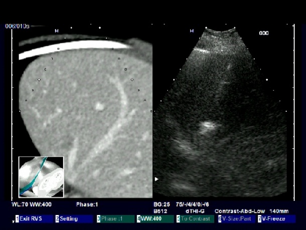 CT and US co-registration