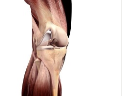 Sigma® High Performance Partial Knee uni-compartmental, bi-compartmental or...