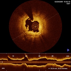 The OCT image includes a cross section view
depicting irregular formations...