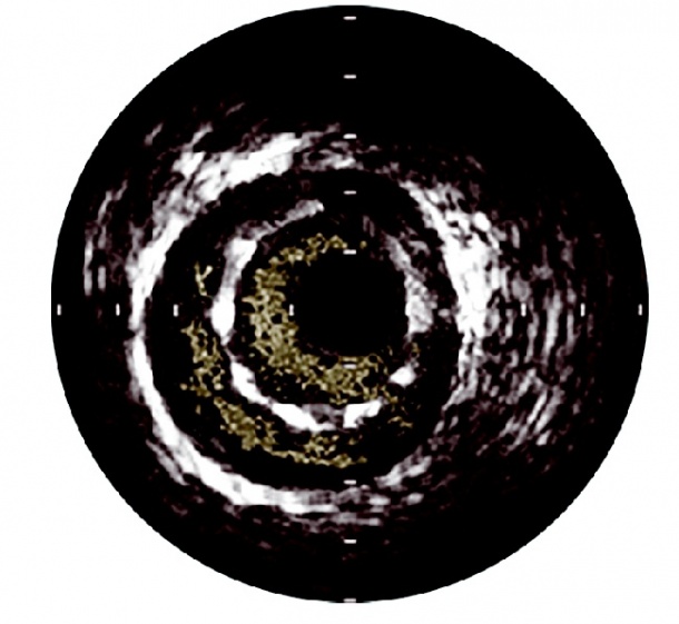 IVUS image reveal stent malapposition
indicated by blood visible behind...