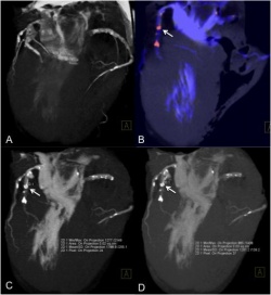 Ex-vivo coronary DECT angiography of the heart of a patient who died from...