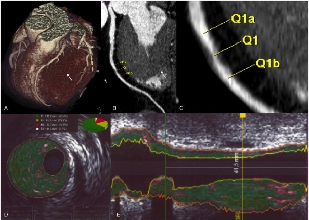 Contrast-enhanced prospectively ECG-triggered cCTA study of a 54-year-old man...