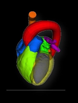 Photo: Herzklappenersatz in der dritten Dimension