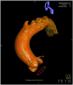 To find the right C-arm angulation for the TAVI (Transcatheter aortic valve...