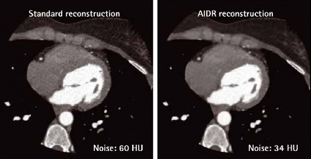 Clinical example of standard and Toshibas AIDR reconstruction. AIDR...