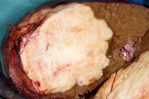 Präparat einer Hemihepatektomie mit fibrosierender Metastase