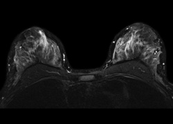 Photo: MRIs may lead to unnecessary breast surgery