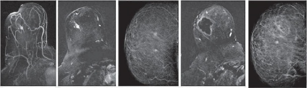 HIFU of breast cancer. 1,2) MRI shows hyperintense nodule of right breast...