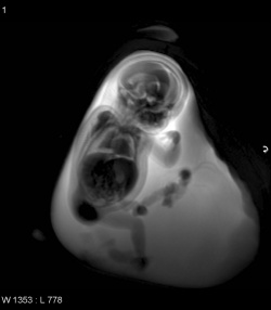 Skeletal dysplasia visualised using MRI