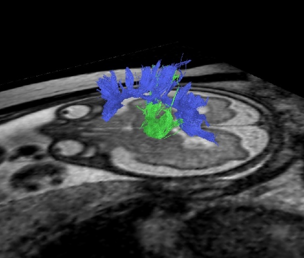 MR tractography of the corticospinal tract and the corpus callosum