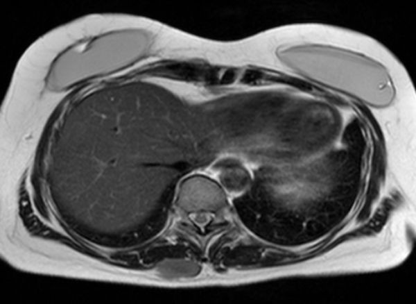 Photo: Diffusion weighted whole body MRI