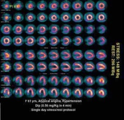 Fig. 1: Stress/rest single day myocardial perfusion imaging with 99mTc...