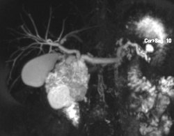 Stenose und Dilatation des Gallen- und Pankreasgangs