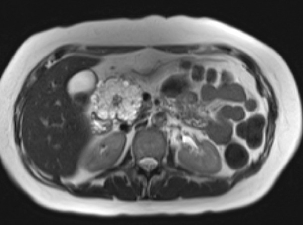 Die 3.0T MRT zeigt ein seröses (mikrozystisches) Adenom des Pankreaskopfes