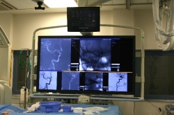 Aneurysm intervention: Configuration for an aneurysm intervention. The working...