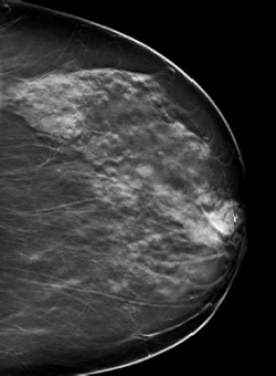 Tomosynthesis slice acquired by the IMS prototype 