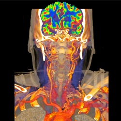 Perfusion after stent closure (Source: Siemens)