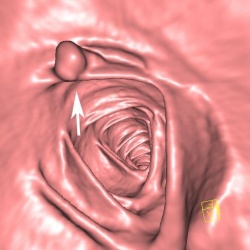 Die virtuelle Endoskopie ist eine interaktive Simulation einer endoskopischen...