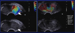 Patient presenting a soft benign nodule in mid peripheral prostate zone (left...