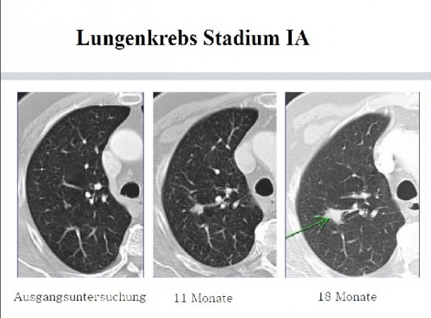 Photo: Neue Studienergebnisse: Früherkennung von Lungenkrebs im CT möglich