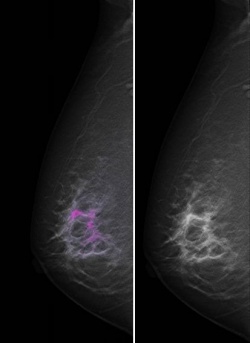 Iodine has been injected to enhance visualisation of the tumour. The picture on...