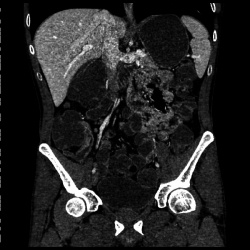 Crohns disease follow-up exam: FBP Reconstruction