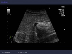 “Hepatocellular Carcinoma (ProSound Alpha 10): a distinct tumour plug is seen...