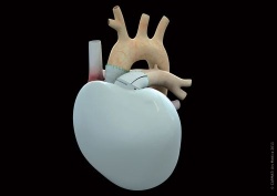 The Carmat artificial heart