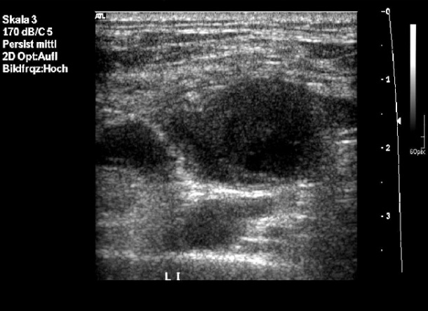 Ultrasound of the lymph nodes