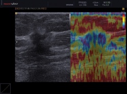 Photo: Elastography in breast ultrasound