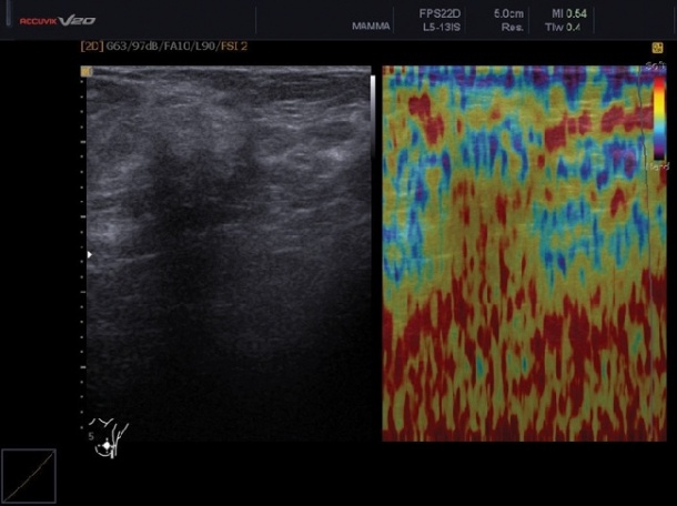 Photo: Elastography in breast ultrasound