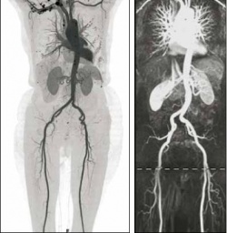 CT-Angiographie (links) Credit: Klinikum
Großhadern
MRT-Angiographie (rechts)...