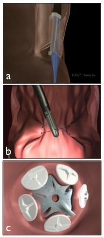 Trail blazing bariatric surgery devices •