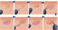 Schematic display of endoscopic submucosal dissection:  a) Marking the...