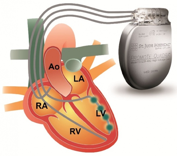 Placing of CRT electrodes -- one in right atrium (RA), one in right Ventricle...