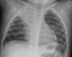 Right upper lobe pneumonia in a 1.5-year-old child 