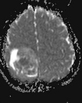 The ADC image of a highly cellular tumour shows a clear, inhomogeneous...