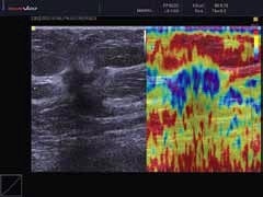 Photo: ElastoScan in breast ultrasound