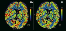 Die dynamische Untersuchung der Hirn-Durchblutung erlaubt die Quantifizierung...