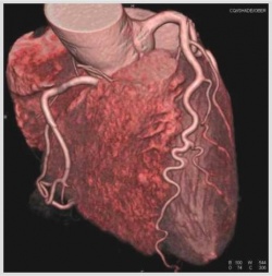Dreidimensionale Darstellung einer CT-Angiographie der Herzkrankgefäße ohne...