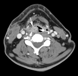 Kontrastmittelverstärkte CT-Aufnahme eines Patienten mit einem Kehlkopftumor...