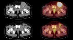 CT und PET-CT eines Patienten mit Non-Hodgkin-Lymphom vor (oben) und nach...